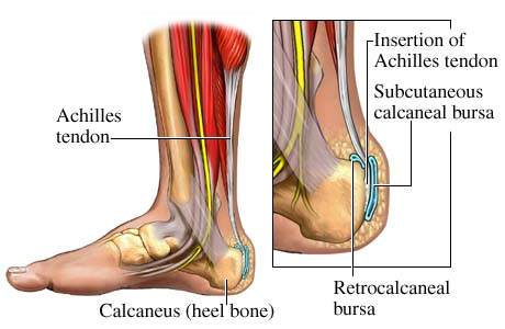 Achilles fájdalom