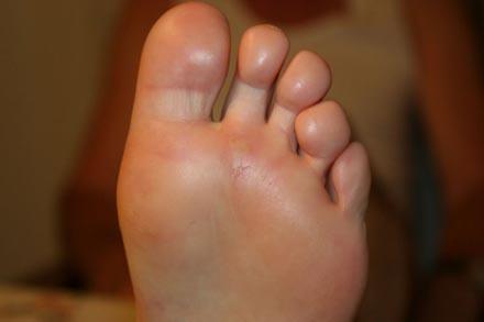 Láb- és körömgomba tünetei és kezelése, Hólyagok a lábujjak között