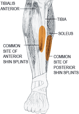 fájdalom a bokán futás után kórtörténet rheumatoid arthritis a csípőízület